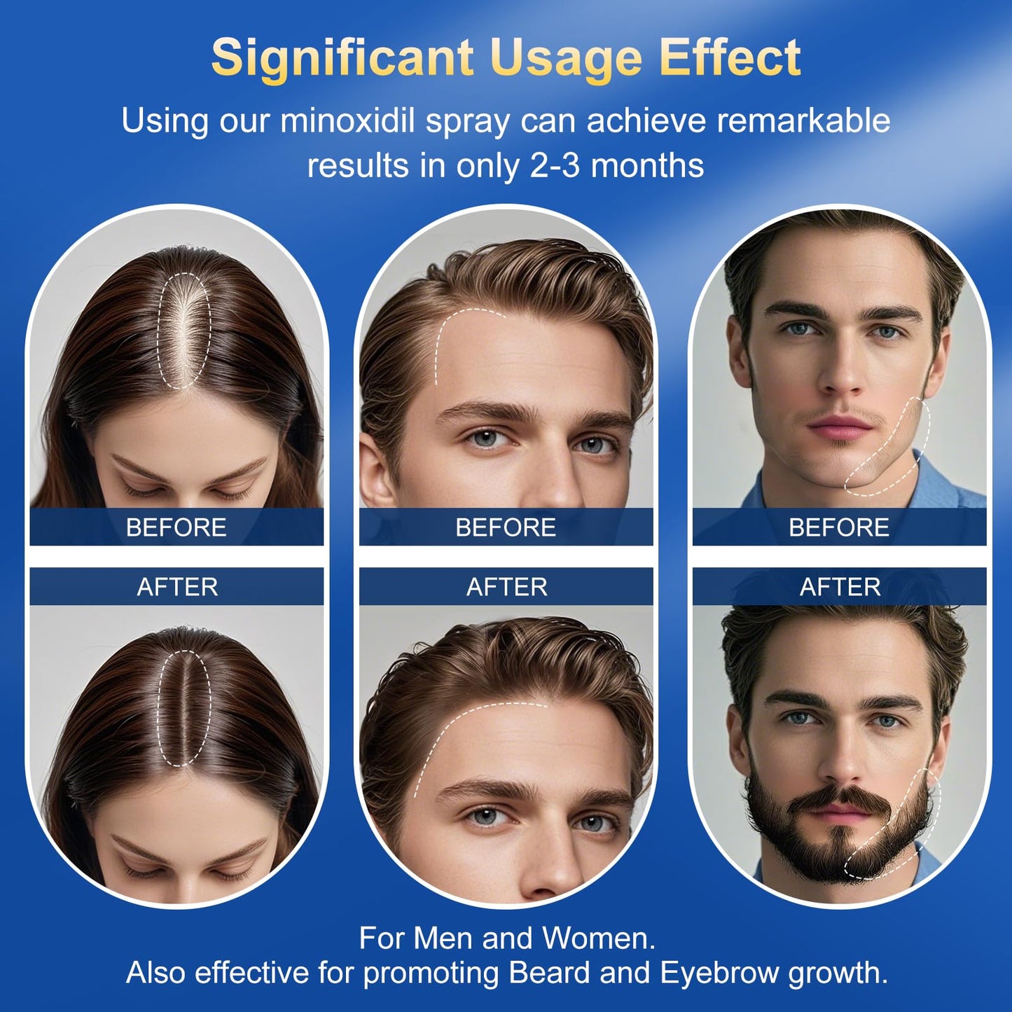 5% Minoxidil Spray for men-Supplied with a minoxidil applicator， Infused with Biotin, Hair Growth Treatment, Supports Thicker and Fuller Hair & Beard (21oz, 10 Month Supply)