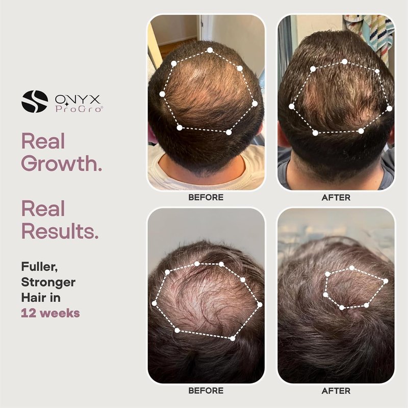 LactoPherma Hair Growth Serum - Oil-Free Formula with 12 Active Ingredients | Boosts Hair Regrowth & Thickening