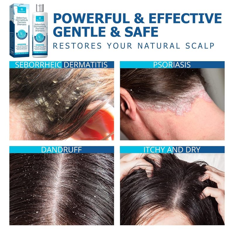 Seborrheic Dermatitis & Psoriasis Shampoo - Relieves Dandruff, Itching & Flaking | 8 oz