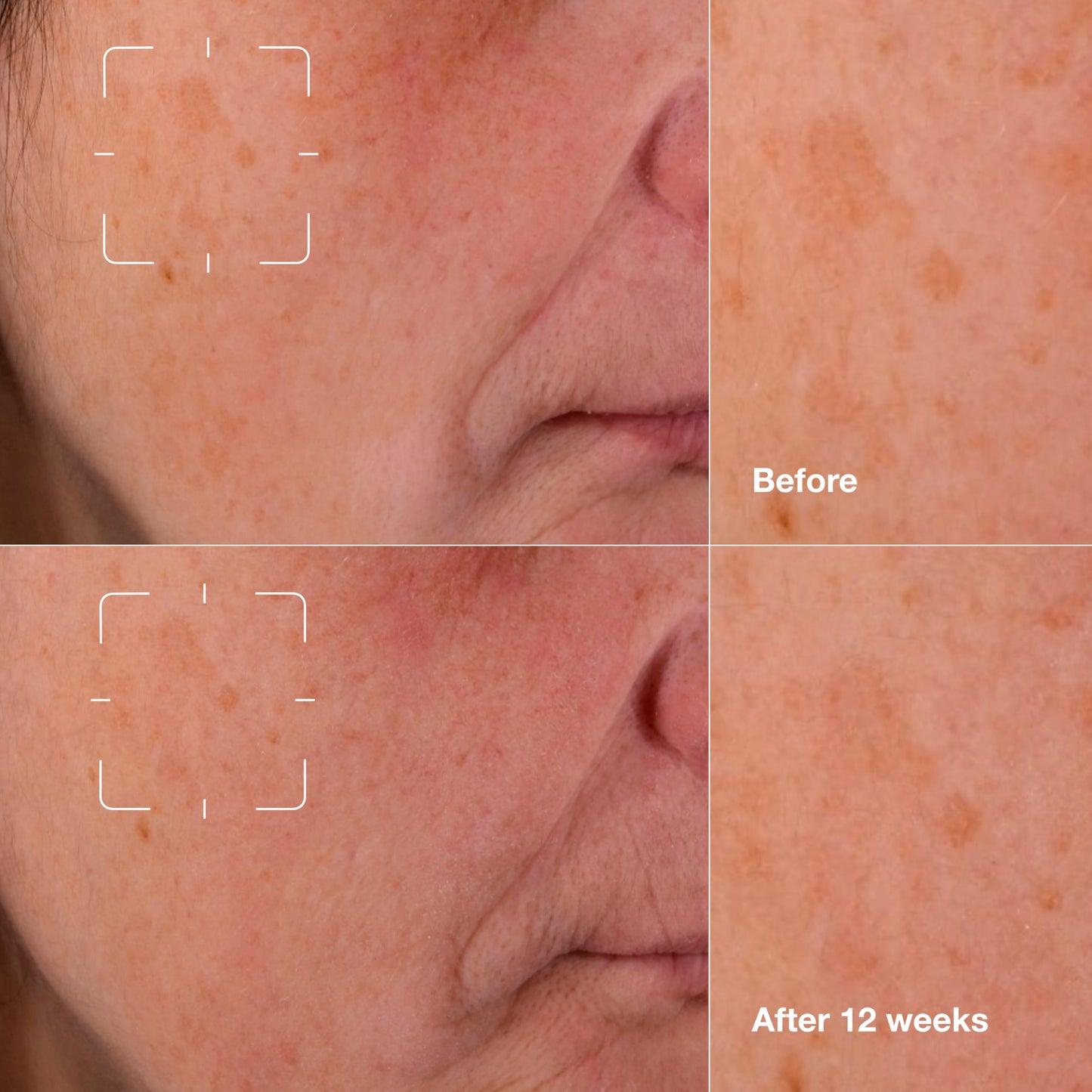 Clinique Even Better Clinical Dark Spot Clearing Vitamin C Face Serum For All Skin Types | Brightening + Soothing, 1 Fl Oz