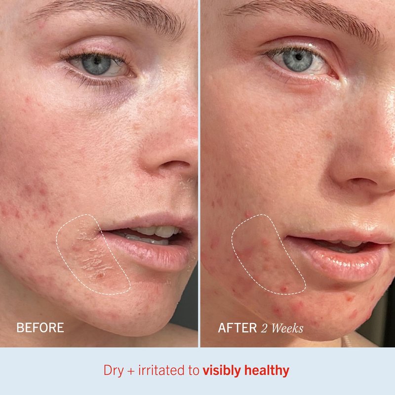 First Aid Beauty - Ultra Repair Cream, Intense Hydration Whipped Colloidal Oatmeal, Clinically Proven to Strengthen Skin Barrier in 7 Days & Helps Relieve Eczema, Luxury Face & Body Moisturizer, 6 oz