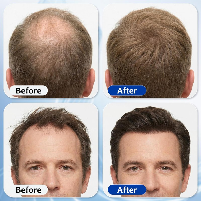 Hair Growth Serum Roll On with 3% Rosemary,3% Batana Oil,2% Pea Extract,2% Ginger Root Oil,Stronger Root,stimulate follicle,Hair Thicker,Hair Loss Treatment,Hair Growth Serum(30ML/1.01FL.OZ)