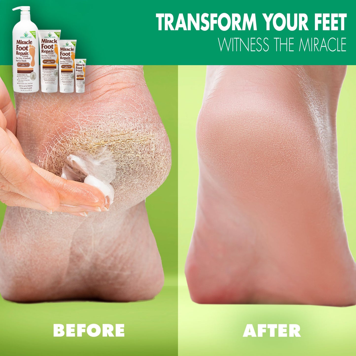 Miracle Foot Repair Cream (8 oz / 3-Pack) Repairs Dry Cracked Heels and Feet, 60% Pure UltraAloe Moisturizes, Softens, and Repairs