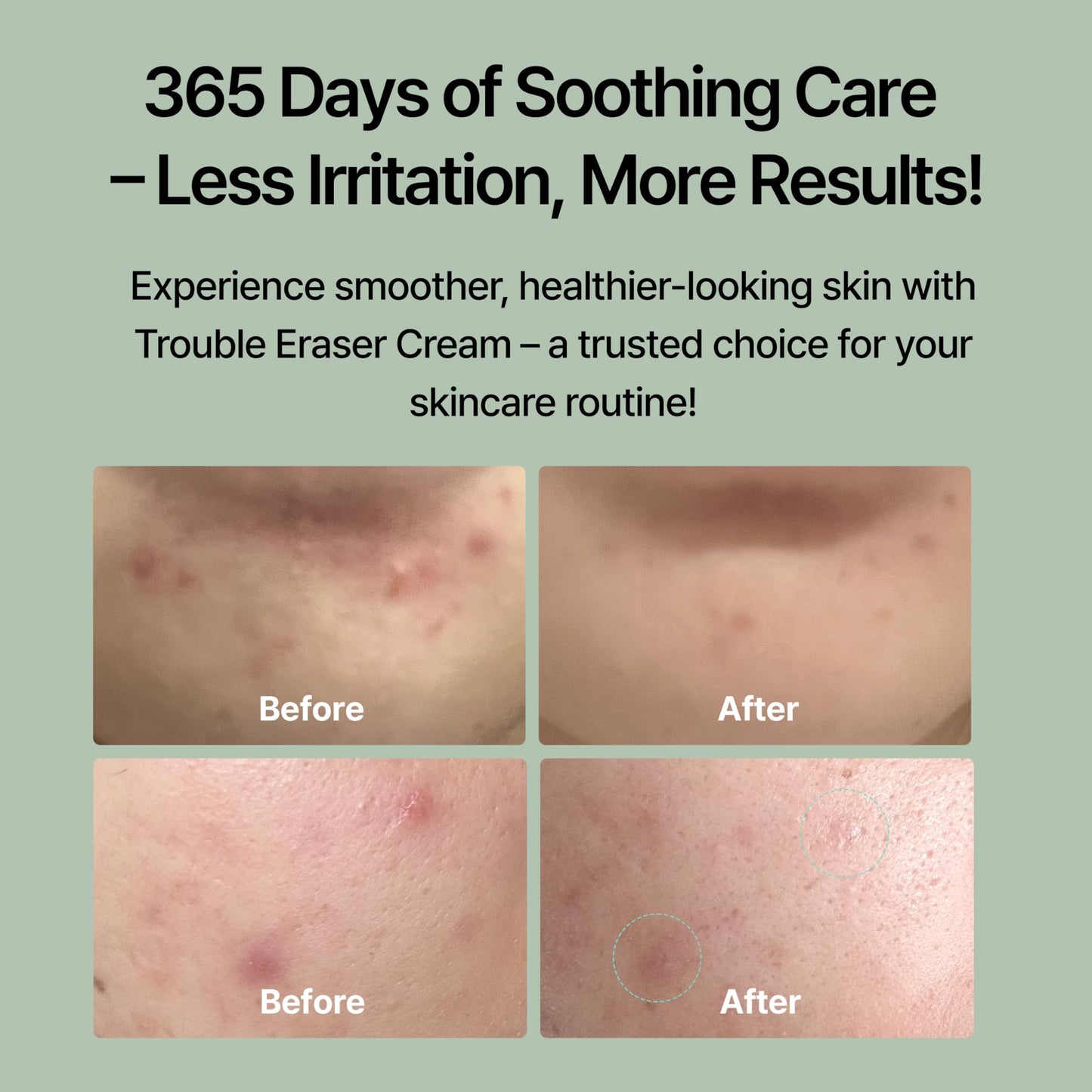 Cica-Exosome Spot Cream (18ml / 0.60 Fl oz) | Post-Blemish Recovery, Soothing, Redness Relief Gel with Madecassoside, Niacinamide, Panthenol for Sensitive Skin – NDP