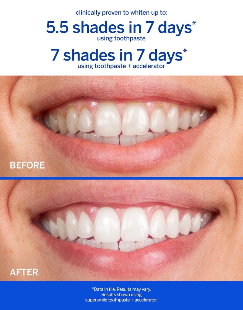 Supersmile Whitening Toothpaste with Fluoride - Clinically Proven to Whiten Teeth Up to 6 Shades, Strengthen Enamel - No Sensitivity, Icy Mint, 4.2 oz