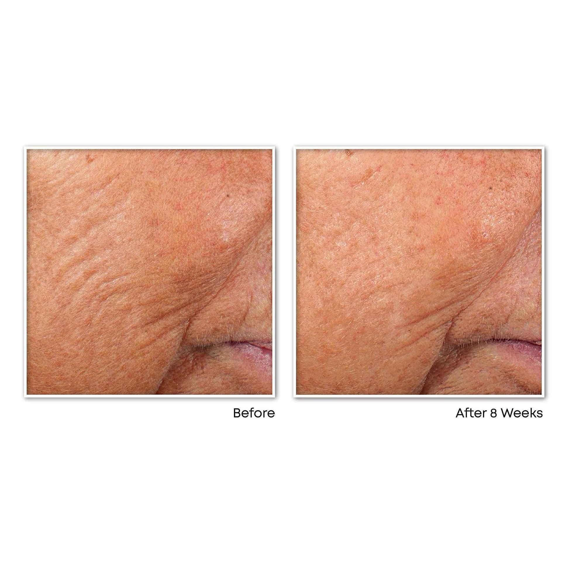 RoC Retinol Correxion Line Smoothing Night Serum Capsules, Daily Anti-Aging Skin Care Treatment for Fine Lines, Dark Spots, Acne Scars, 10 Count (Pack of 2)