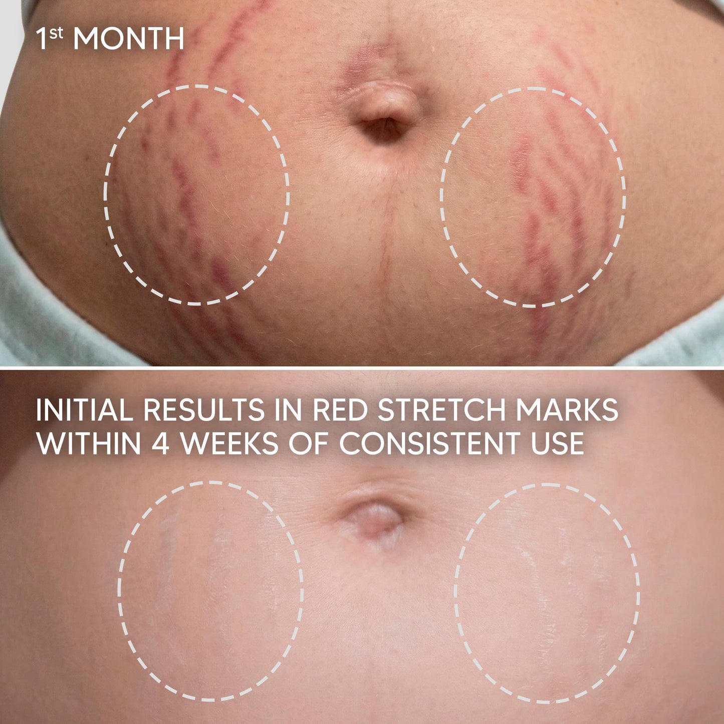 Cicatrissim Targeted Stretch Mark Cream for Red, Purple, and Recent Striae - Softens Stretch Marks, Evens Skin Tone, and Supports Firmer Skin - All Skin Types - 5.3 oz