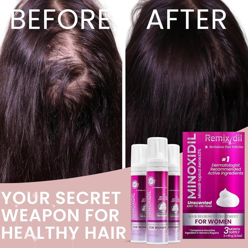 Minoxidil for Women - 5% Hair Growth Foam | Unscented, Dermatologist Recommended | 3-Month Supply