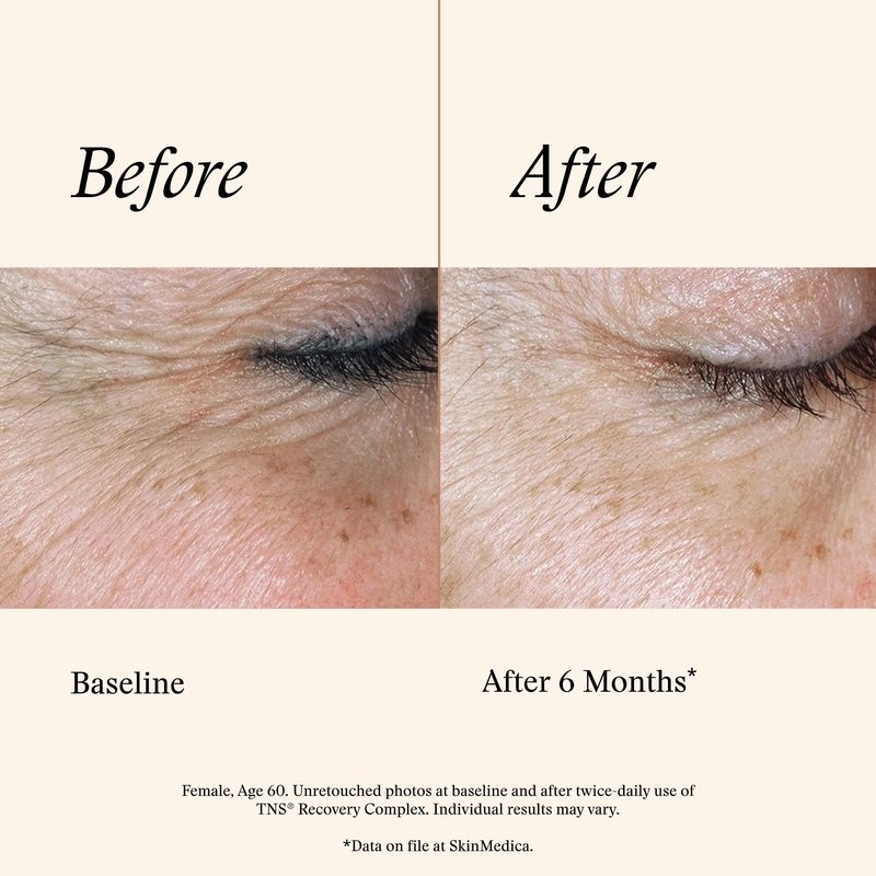 SkinMedica TNS Recovery Complex Facial Treatment - Advanced Growth Factor & Exosome Formula for Skin Rejuvenation - Helps to Improve the Appearance of Fine Lines, Wrinkles, and Uneven Skin Tone (1 Oz)