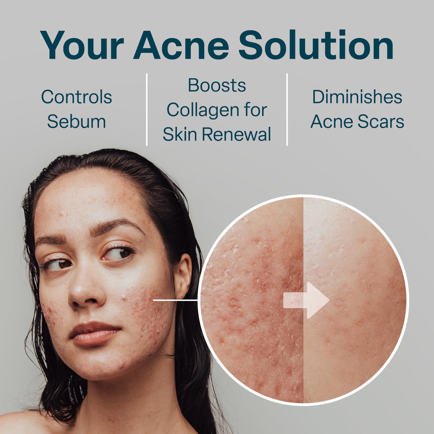 QRxLabs Salicylic & Glycolic Acid Acne Clearing Pads - 2% Salicylic & 10% Glycolic Acid - Exfoliating Pads for Acne, Bacne, Butt Acne, Body Acne - Daily Pads - 50ct