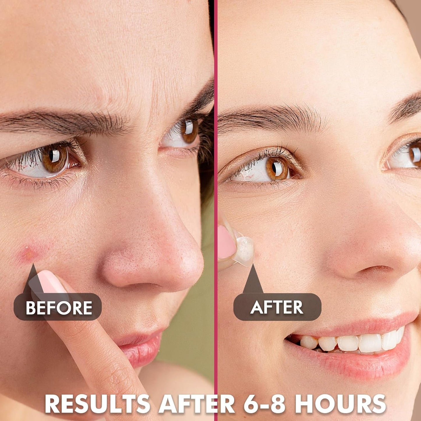 Albatross Health New England Invisible Pimple Patches for face, plain Hydrocolloid Acne Patches, HSA FSA eligible, Spot Dots Cover, Zit Blemish Patch, 2 Sizes 180 Counts