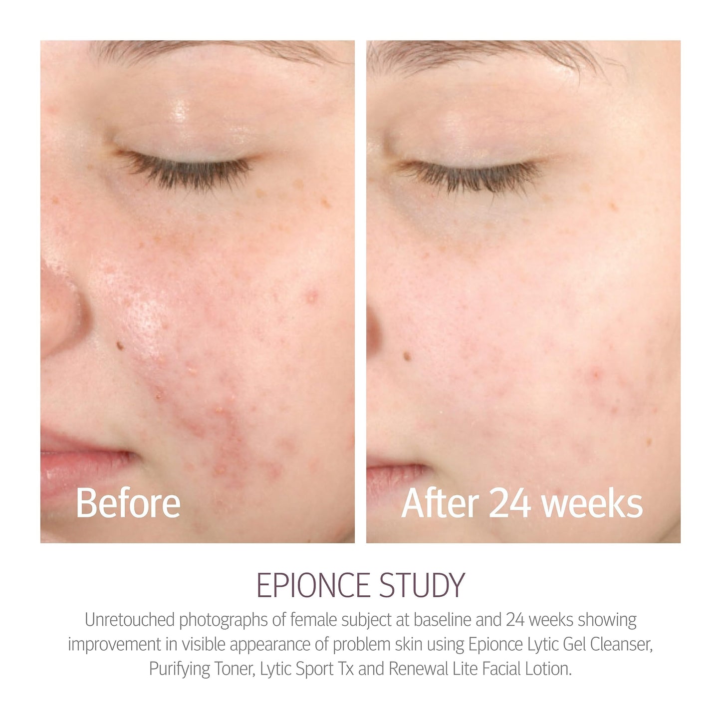 Epionce Purifying Toner – Acne & Blackhead Control Toner for Face & Body | Removes Dirt, Oil & Makeup | Willow Bark, Cucumber & Menthol | Dermatologist-Developed Skincare