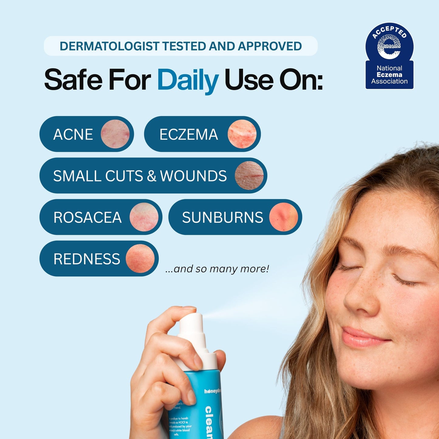 Hypochlorous Acid Spray – Dermatologist Tested HOCl Facial Cleanser for Sensitive, Acne-Prone & Irritated Skin Soothes Redness, Eczema, Rashes & Itching – Skin Repair Spray, 2oz + 6.8oz, Honeydew Labs