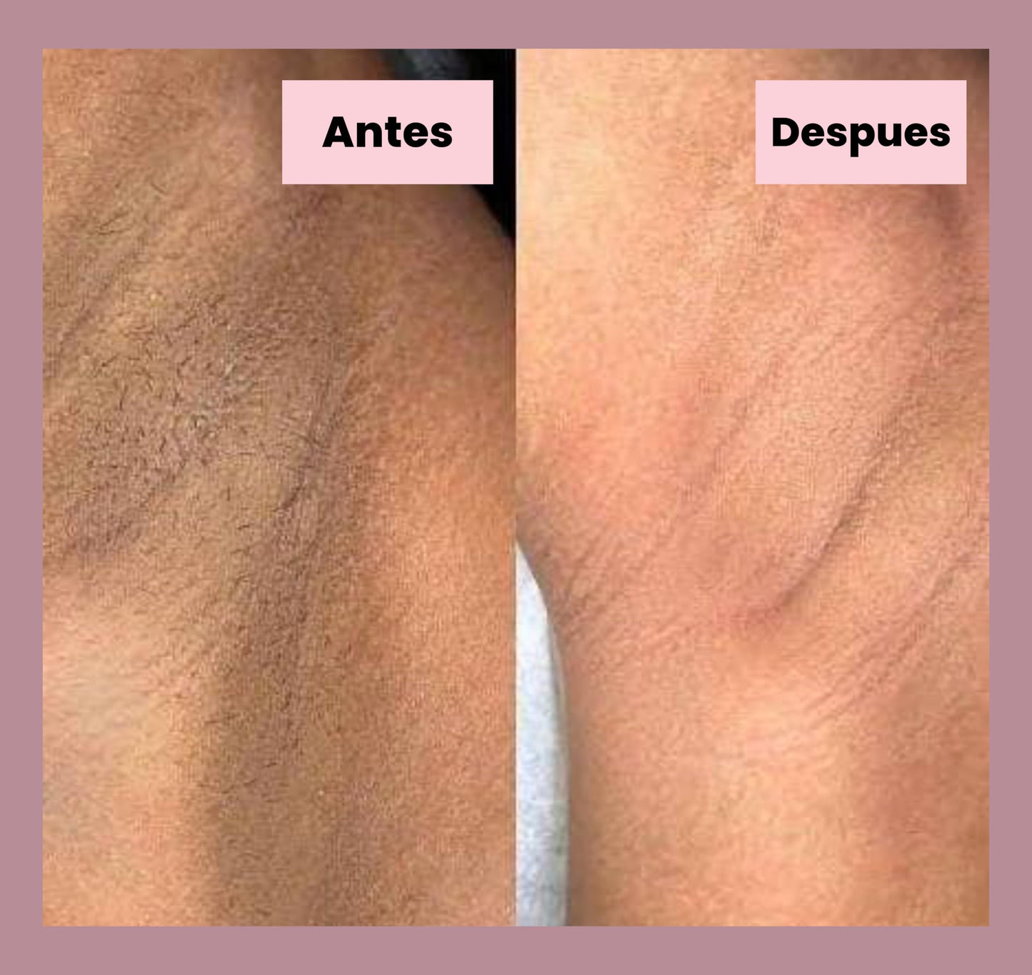 Generic Tonico Despigmentante LB *Elimina pecas, barros, paños, melasma*