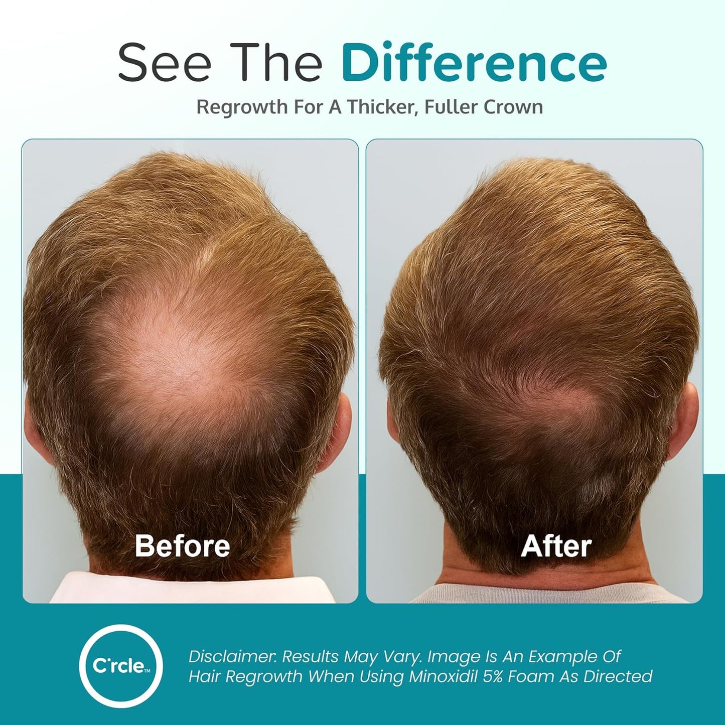 Minoxidil Foam for Men - 5% Extra Strength Hair Regrowth Treatment | Unscented 3-Month Supply