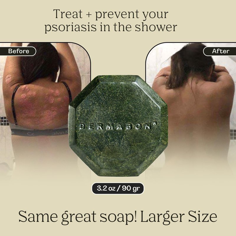 Dermabon Psoriasis, Dermatitis & Dandruff Control Soap Bar with 2% Coal Tar as Active Ingredient for Eczema Relief - 1 Pack