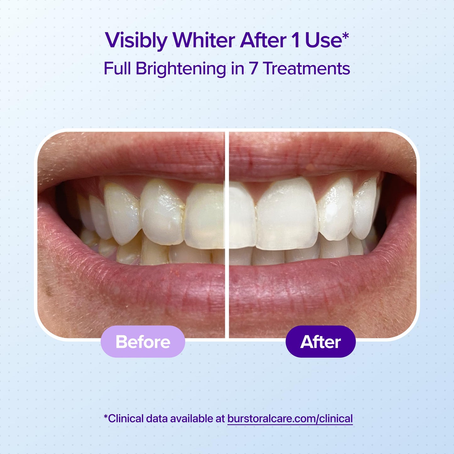 BURST Sensitive Teeth Whitening Strips (Mint) | 20 Strips/10 Treatments – Each with 1 Upper/1 Lower | Visible Results in 15 Minutes | No-Slip Grip | Enamel-Safe Whitening Kit