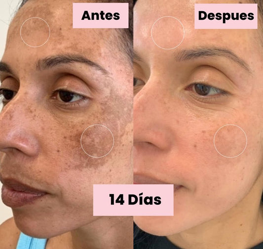Generic Tonico Despigmentante LB *Elimina pecas, barros, paños, melasma*