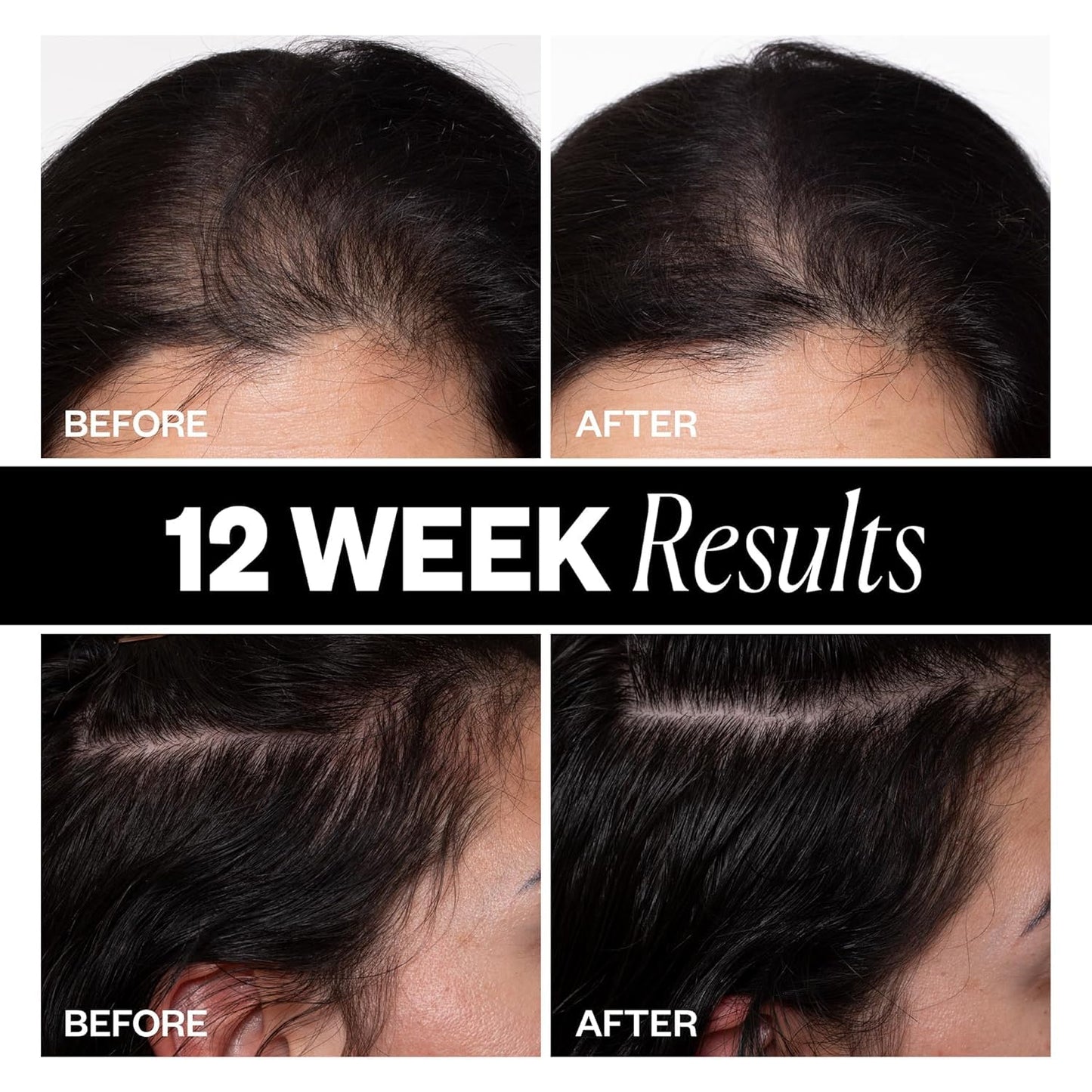 IGK Hair Thickening Treatment Set | Sponsored Density Scalp Treatment + Body Language Thickening Spray | For Hair Loss and Thinning | 2.1 oz + 7 oz