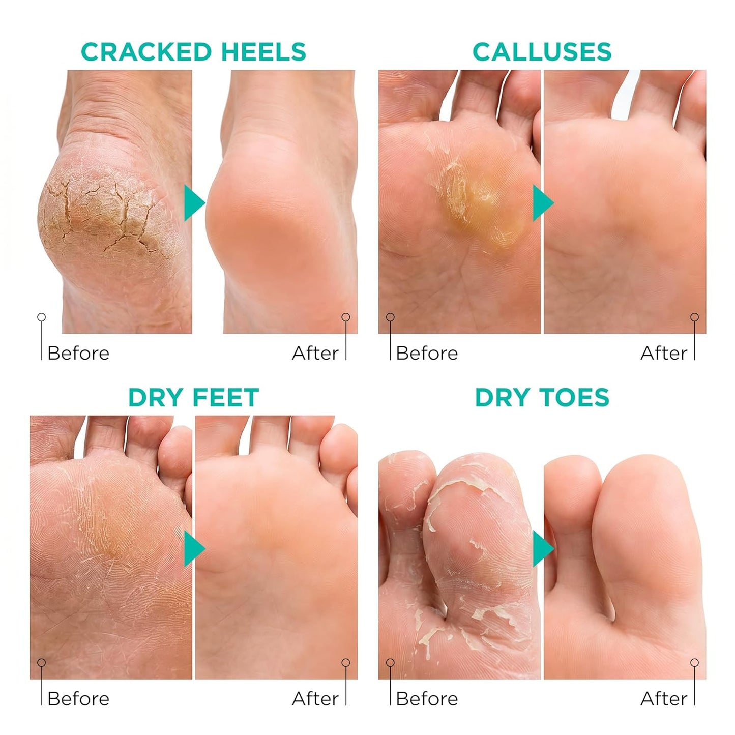 Lavinso Foot Peel Mask - Exfoliating Treatment for Dry, Cracked Feet | 2-Pack Peeling Mask for Soft, Smooth Skin