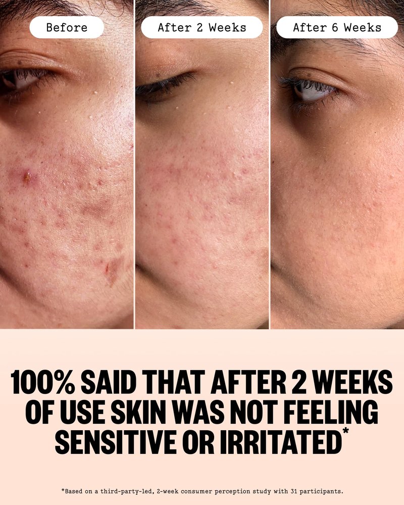 PEACE OUT Acne Serum with 2% Salicylic Acid and Niacinamide, Daily Acne Face Treatment to Help Unclog Pores, Reduce Pimple Breakouts, Blackheads, and Improve Skin Texture (1 fl oz)