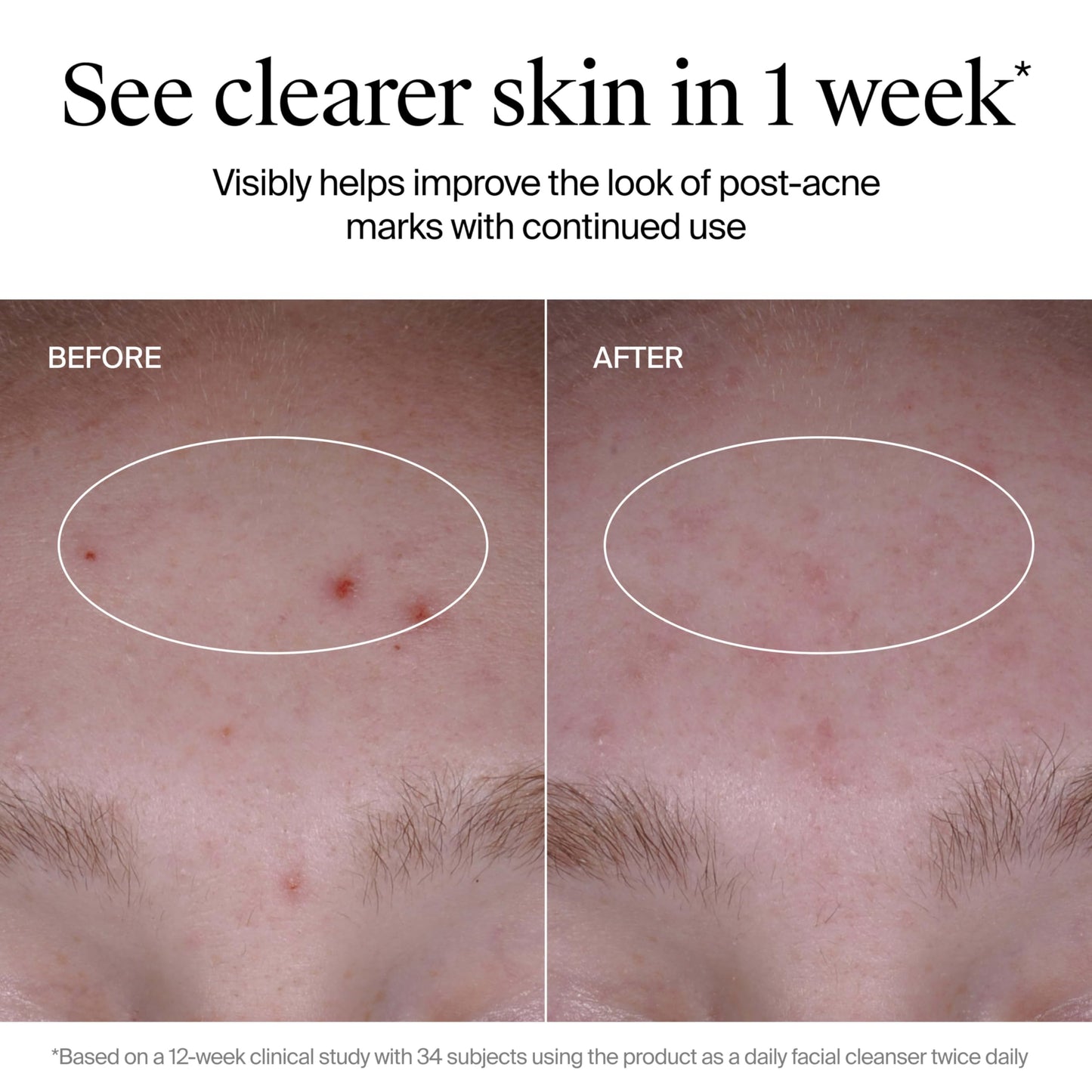 Neutrogena Evenly Clear Acne Cleanser with 2% Salicylic Acid & 2% PHA Exfoliant, Gentle Foaming Face Wash Clears Clogged Pores & Blackheads While Visibly Fading Look of Post-Acne Marks, 9.1 fl. oz