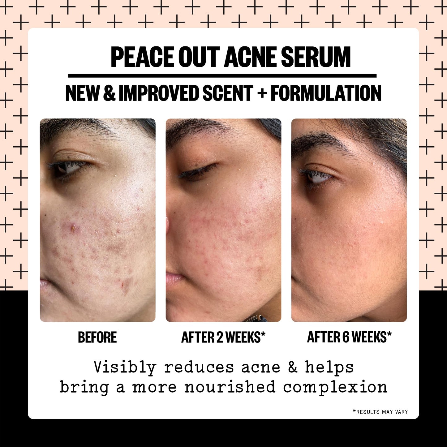 PEACE OUT Skincare Acne Serum. Daily Multi-Benefit Face Serum with 2% Salicylic Acid to Target Pimples, Zits, Blemishes and Breakouts, For Clearer-Looking Skin 1 fl oz