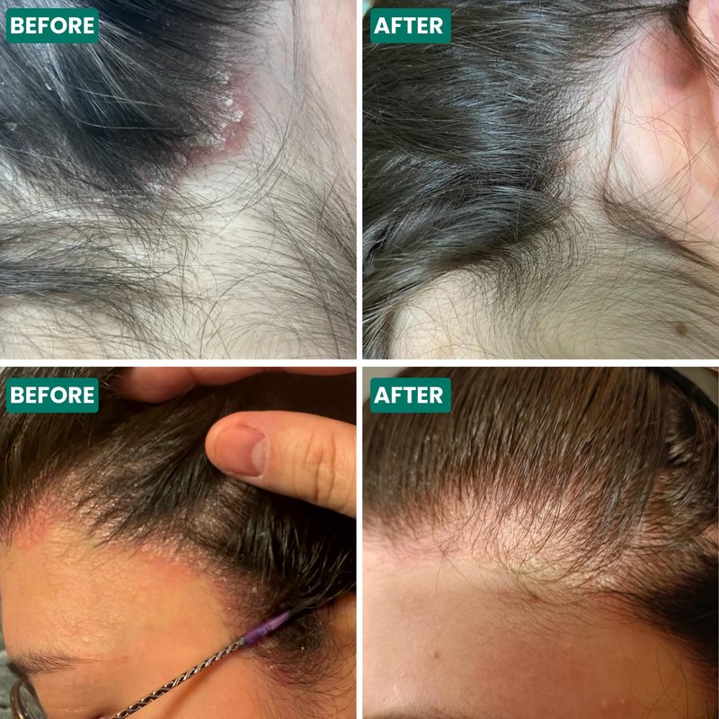 Grahams Natural Scalp Relief Oil - For Dry, Itchy & Flaky Scalp Psoriasis, Seborrheic Dermatitis & Dandruff Treatment - Hydrating, Moisturising & Exfoliating Scalp Oil (1 x 3.38 fl oz)
