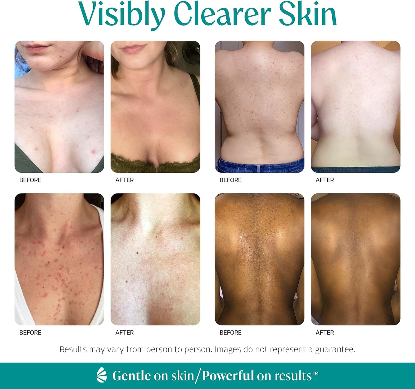 Body Clearing Serum - Level 2 Acne Treatment with Mandelic Acid for Back, Chest, Thighs | 1 Fl Oz