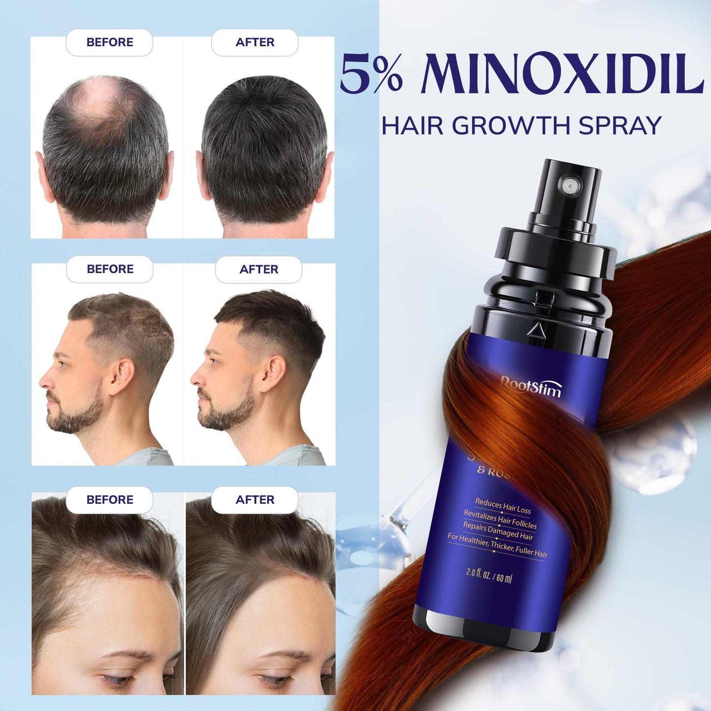 Minoxidil 5% Hair Growth Spray for Men and Women, 2-Pack
