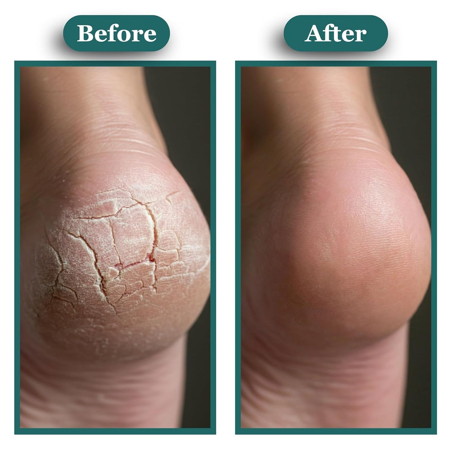 Kissable Feet Athletes Foot Cream - Soothing Relief for Itchy, Dry Skin with Tea Tree, Coconut & Chamomile | 3.5 oz