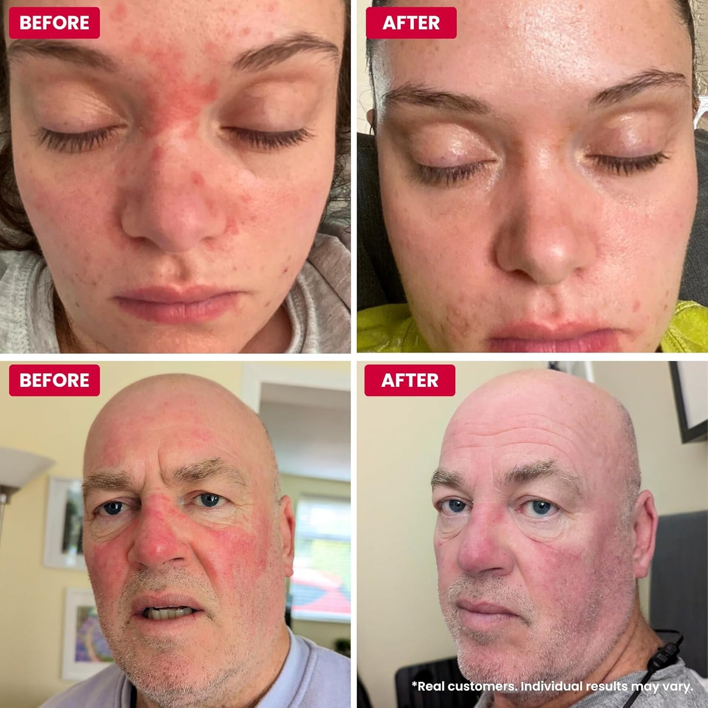 Natural Rosacea Treatment - Anti-Redness Face Cream to Soothe Flare-Ups | Hypoallergenic, Steroid-Free (2.64 fl oz)
