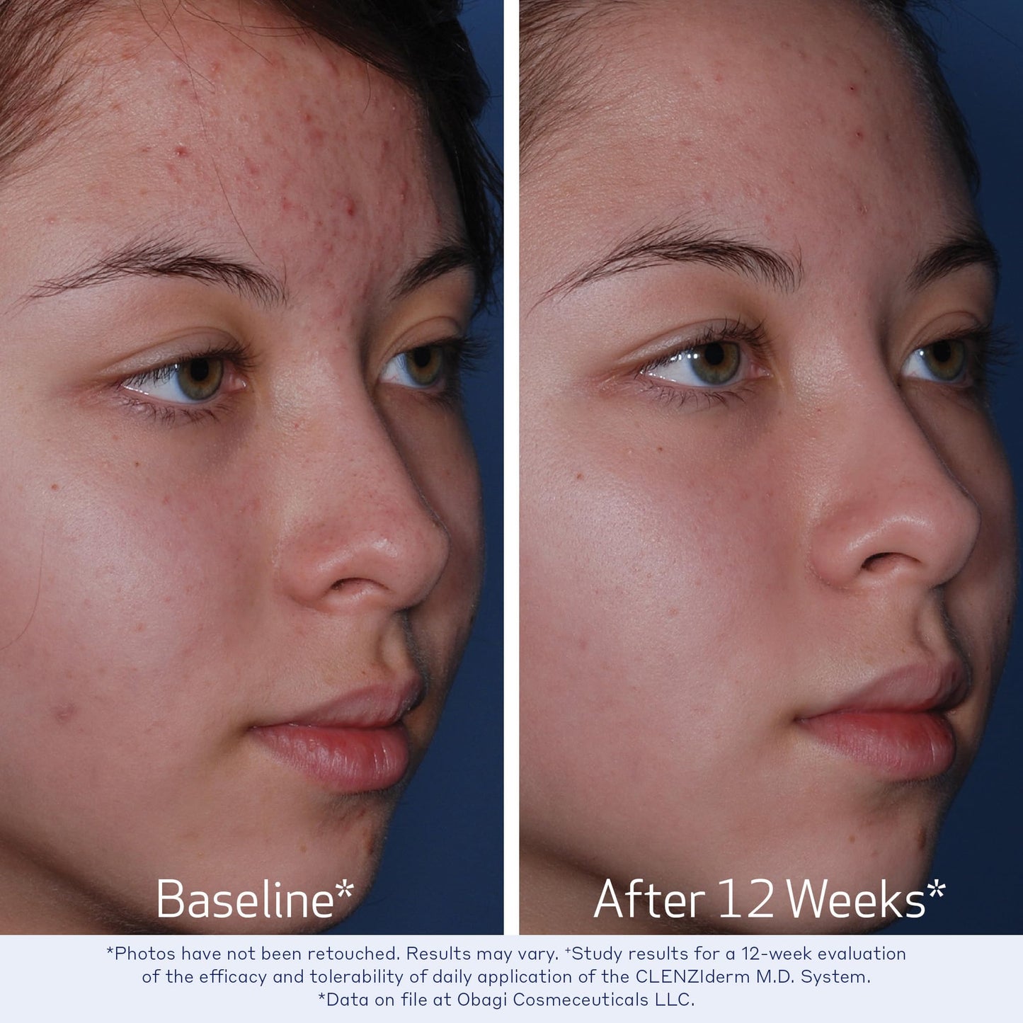 Obagi CLENZIderm M.D. Therapeutic System – 3 Step Acne Treatment System Includes 2% Salicylic Acid (BHA) Cleanser, 2% Salicylic Acid (BHA) Exfoliating Toner, 5% Benzoyl Peroxide (BPO) Acne Treatment