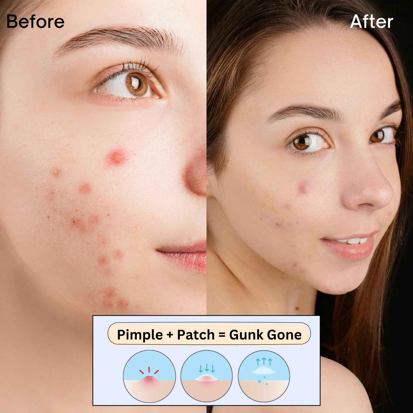 Sporty Acne Patches – Hydrocolloid Spot Cover for Zits, Pimples & Blemishes, Fast-Acting Formula, Long-Lasting & Gentle on Skin. (36 Count)