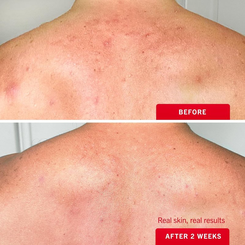 Body Acne Spray - Fast-Acting Treatment for Clear Skin | 6 oz