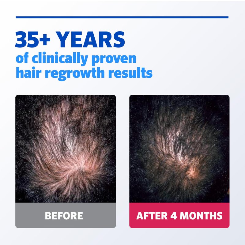 Men's Rogaine Extra Strength 5% Minoxidil Topical Solution for Hair Loss & Regrowth, Topical Treatment for Men, Unscented Minoxidil Follicle Booster Solution, 1-Month Supply, 2 fl. oz