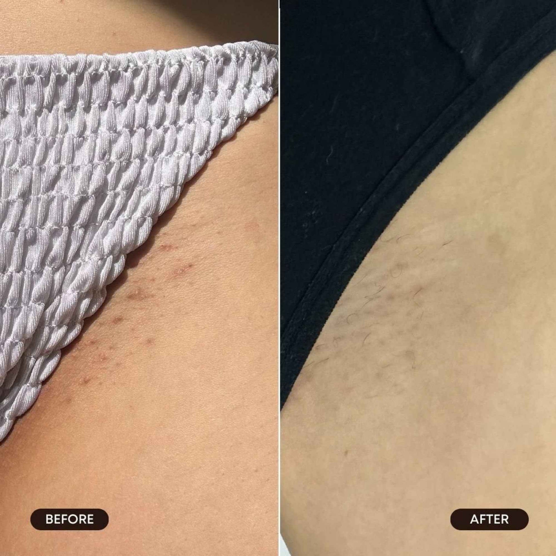 Bushbalm Roller Rescue Ingrown Hair Serum, Includes AHA and BHA - Exfoliating, Soothing, Cooling for Intimate Areas, Underarms - Helps With Razor Bumps and Ingrown Hairs, Blue 50 ml