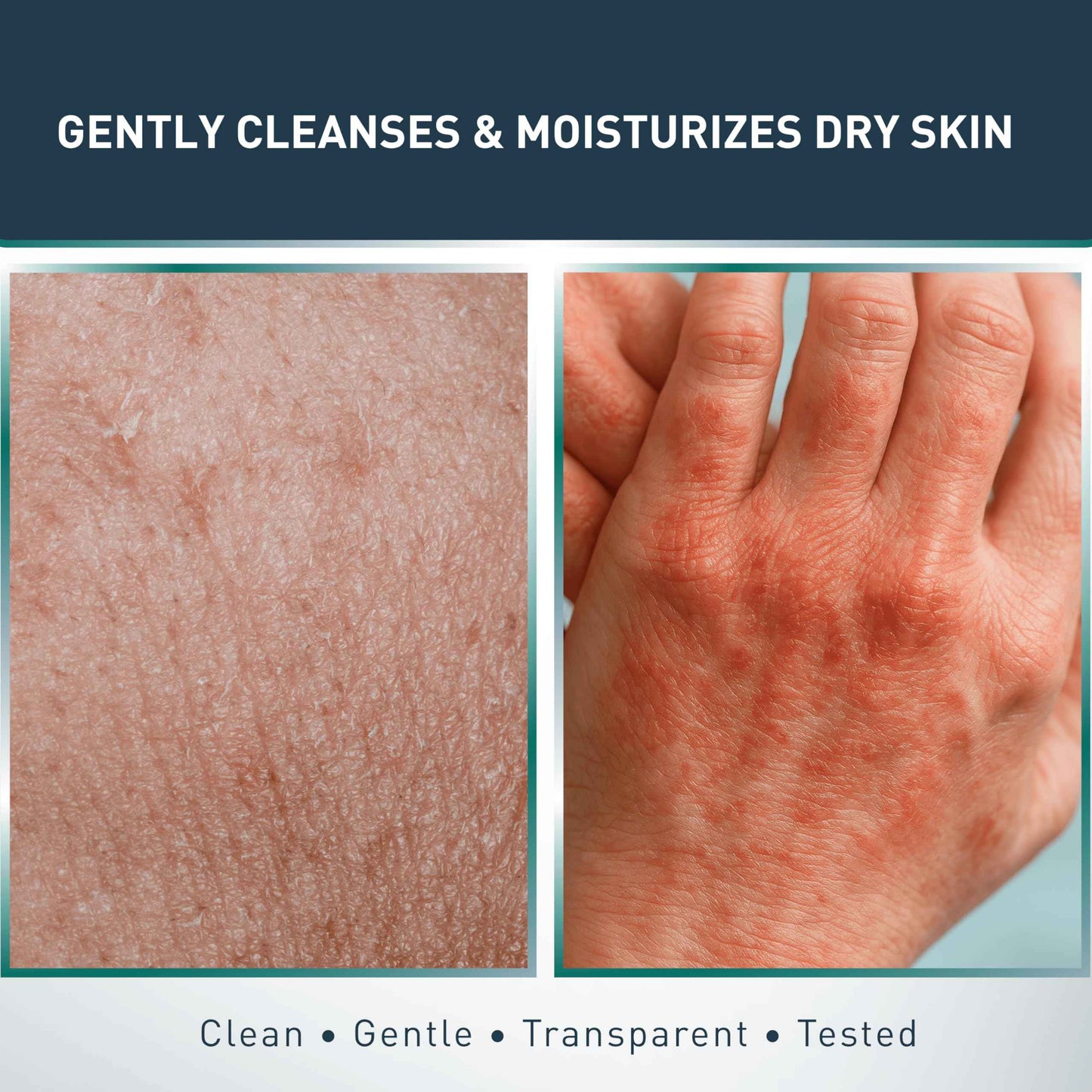 Jericho Psoriasis Dead Sea Salt Soap Bar with Olive Oil & Witch Hazel, Natural Exfoliating Face & Body Cleansing Bar for Sensitive Skin, 4.4 Oz / 125 g (Pack of 6)