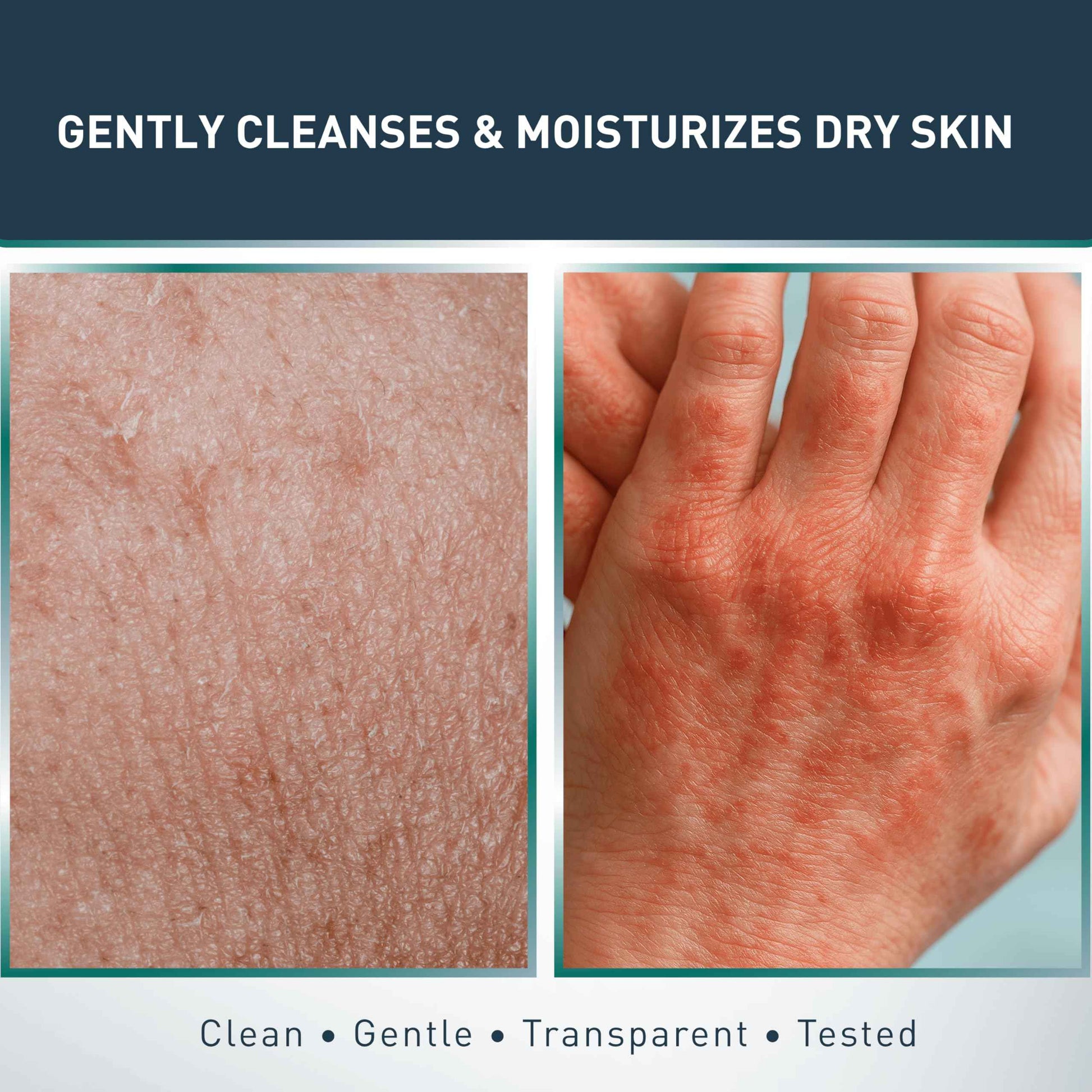 Jericho Psoriasis Dead Sea Salt Soap Bar with Olive Oil & Witch Hazel, Natural Exfoliating Face & Body Cleansing Bar for Sensitive Skin, 4.4 Oz / 125 g (Pack of 6)