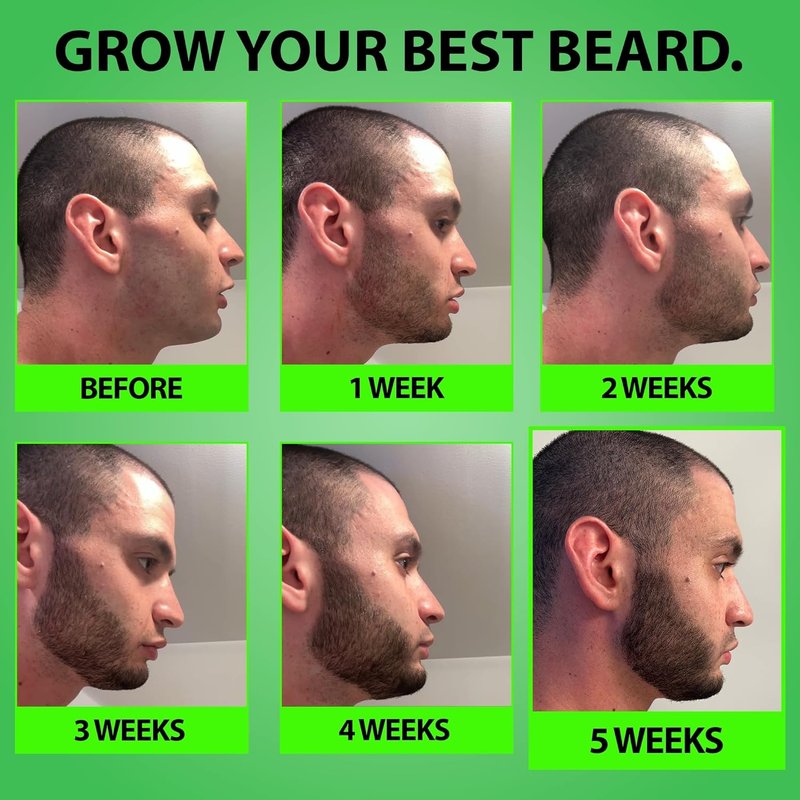 Minoxidil Beard Growth Serum - 5% Formula with 2X Biotin & Rice Water for Thicker, Fuller Facial Hair | Ideal for Patchy Areas