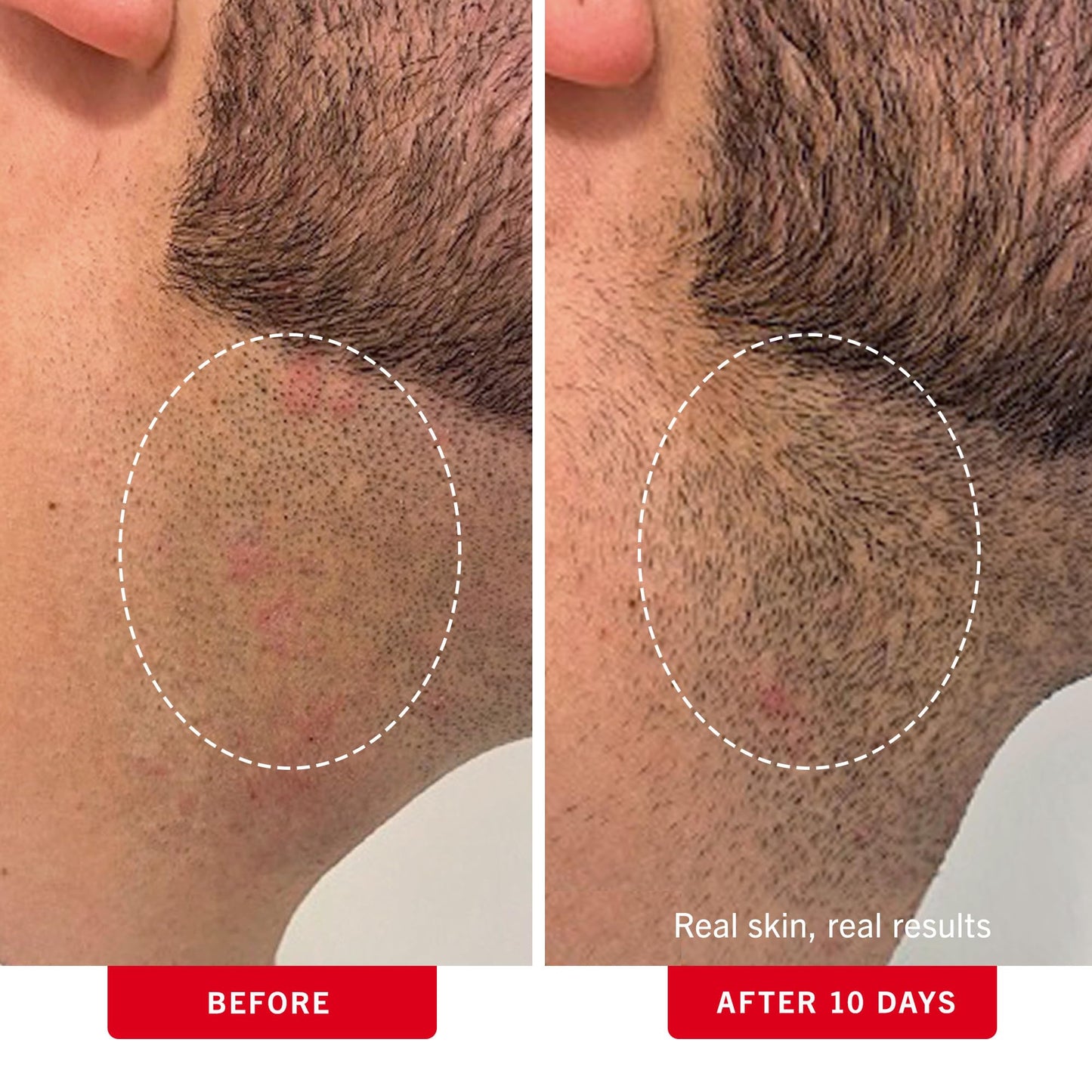First Aid Beauty - Ingrown Hair Pads with BHA + AHA - Aftershave Treatment Pads Help Men & Women Prevent Razor Bumps, Exfoliate Underarms & Bikini Area, Compostable for Daily Use - 3ct, 84 Pads Total