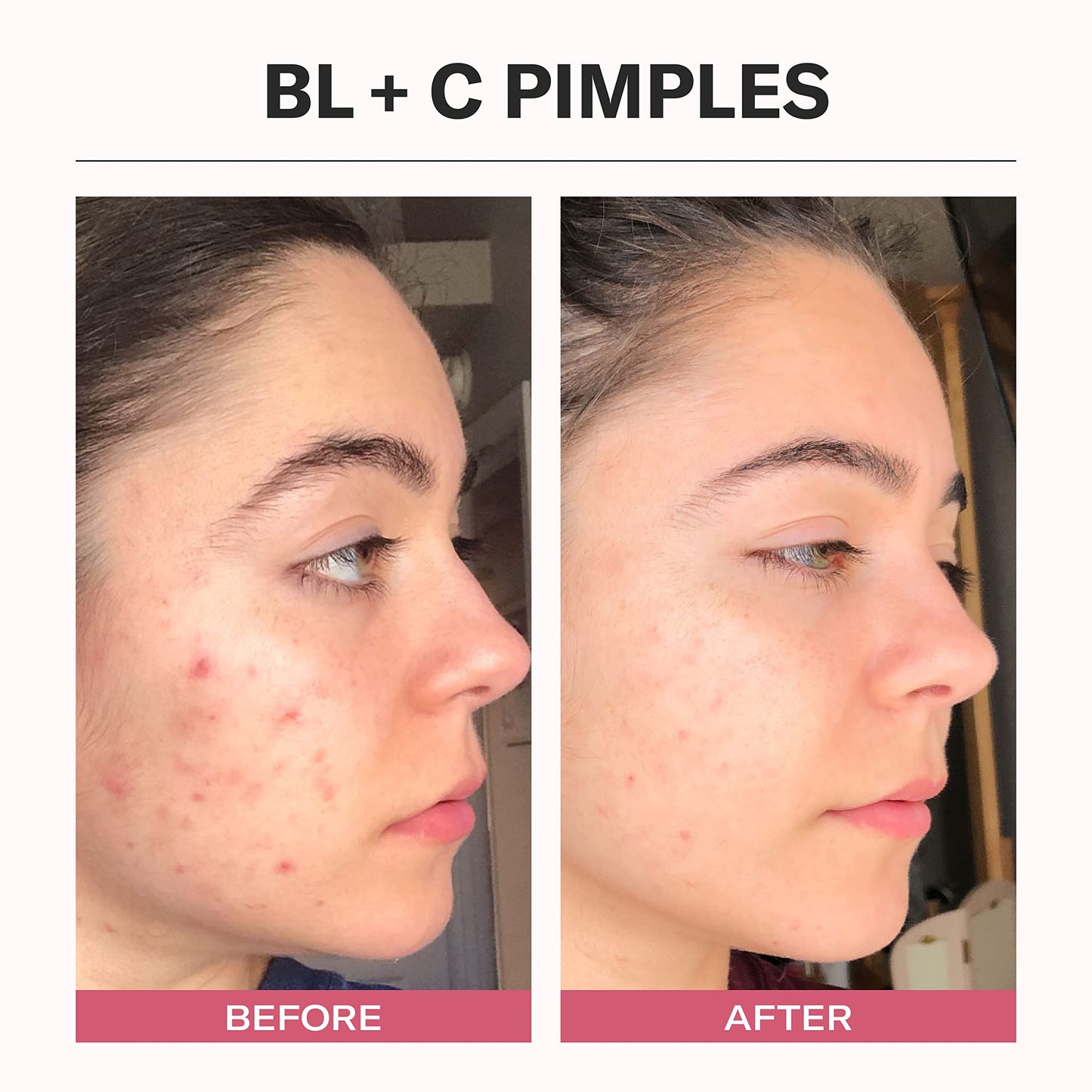 Odacité Bl+C Serum Concentrate for Face, Luxury Black Cumin + Cajeput Pore-Clearing Facial Oil for Pimples & Blemishes, Vegan Vitamin E Spot Treatment for Oily, Acne-Prone Skin, 0.17 fl oz