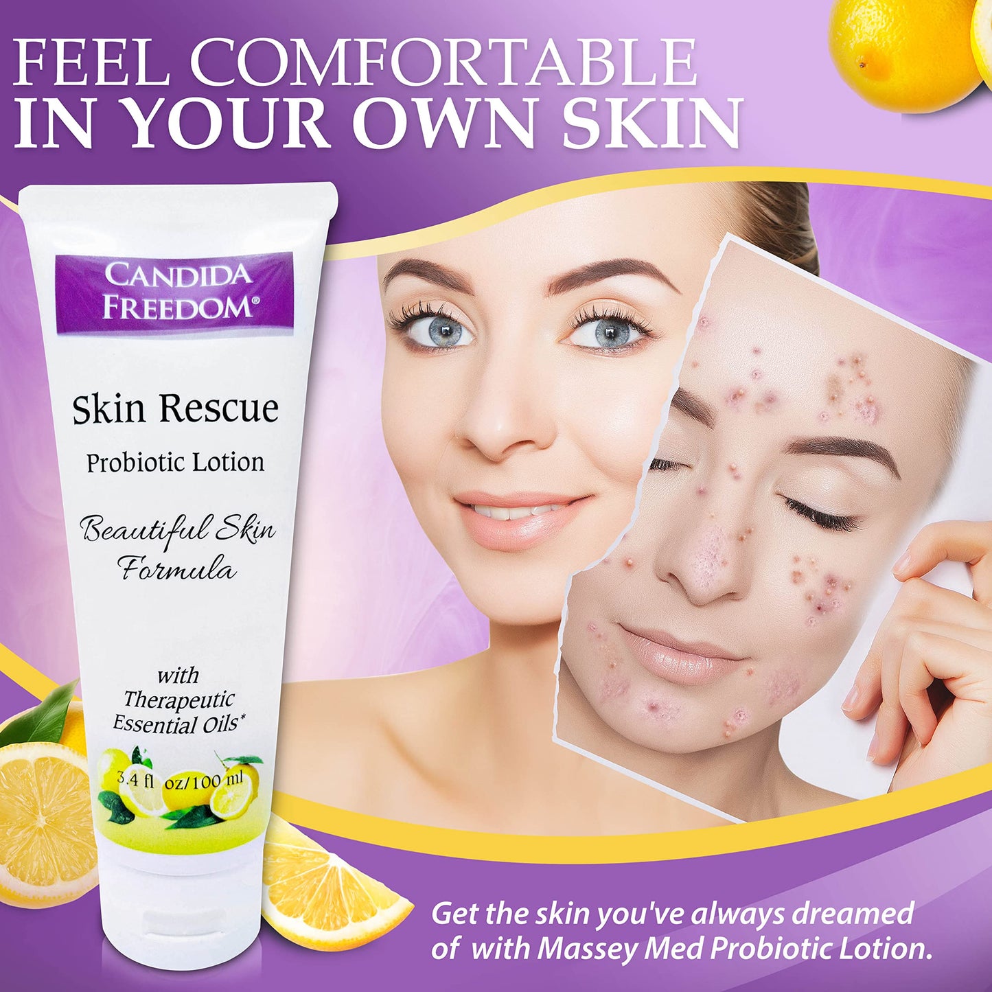 Candida Freedom Massey's Skin Rescue Probiotics Lotion - Daily lotion for Men & Women - Refreshing Lemon Scent - Non-Greasy Moisture for Smooth & Sensitive Skin - 3.4 oz
