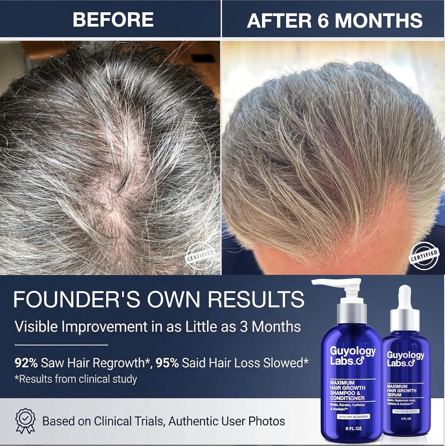 Hair Growth Serum - DHT Blocker for Men & Women | Thickening Formula with Biotin & Caffeine, 4% AnaGain™