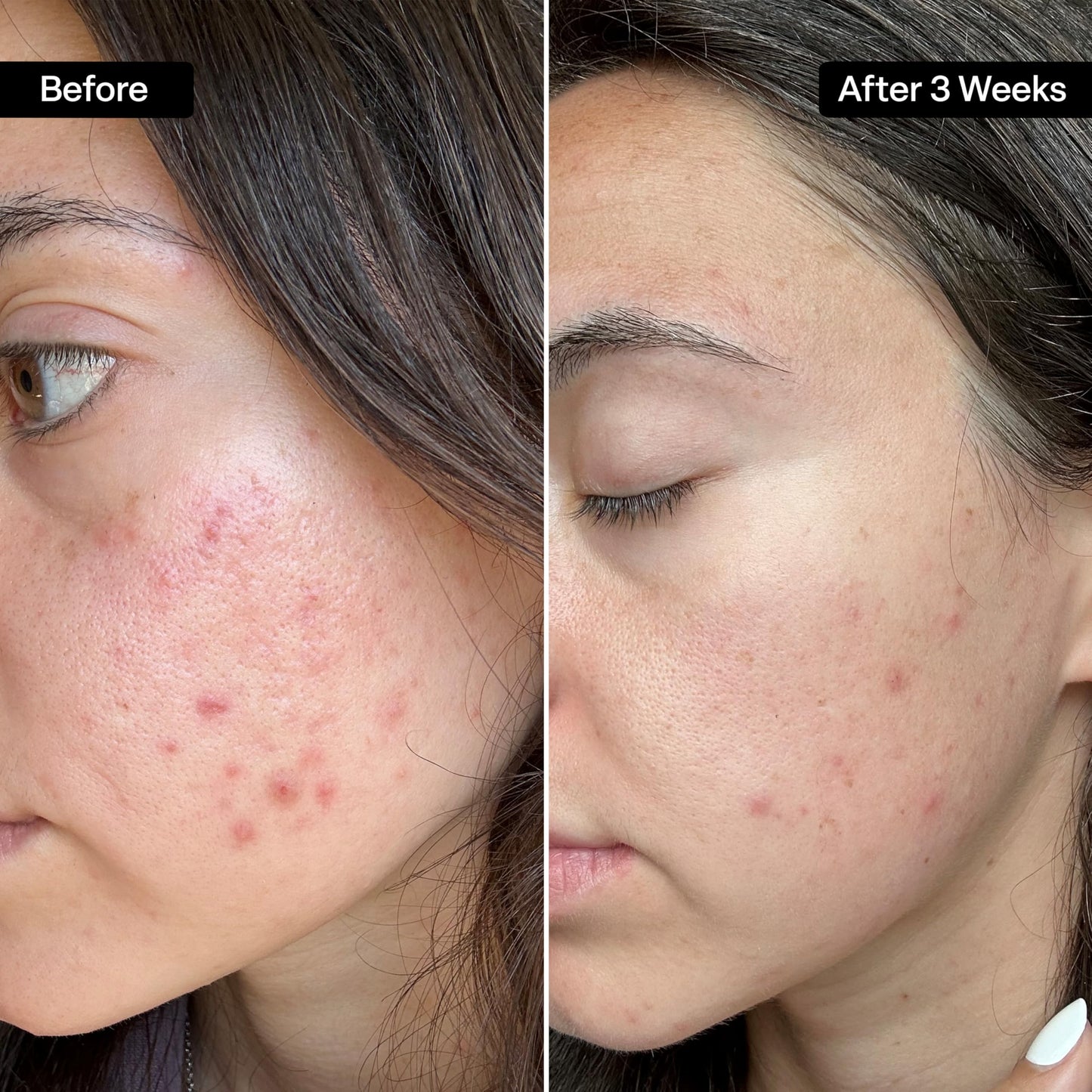 QRxLabs Salicylic & Glycolic Acid Acne Clearing Pads - 2% Salicylic & 10% Glycolic Acid - Exfoliating Pads for Acne, Bacne, Butt Acne, Body Acne - Daily Pads - 50ct