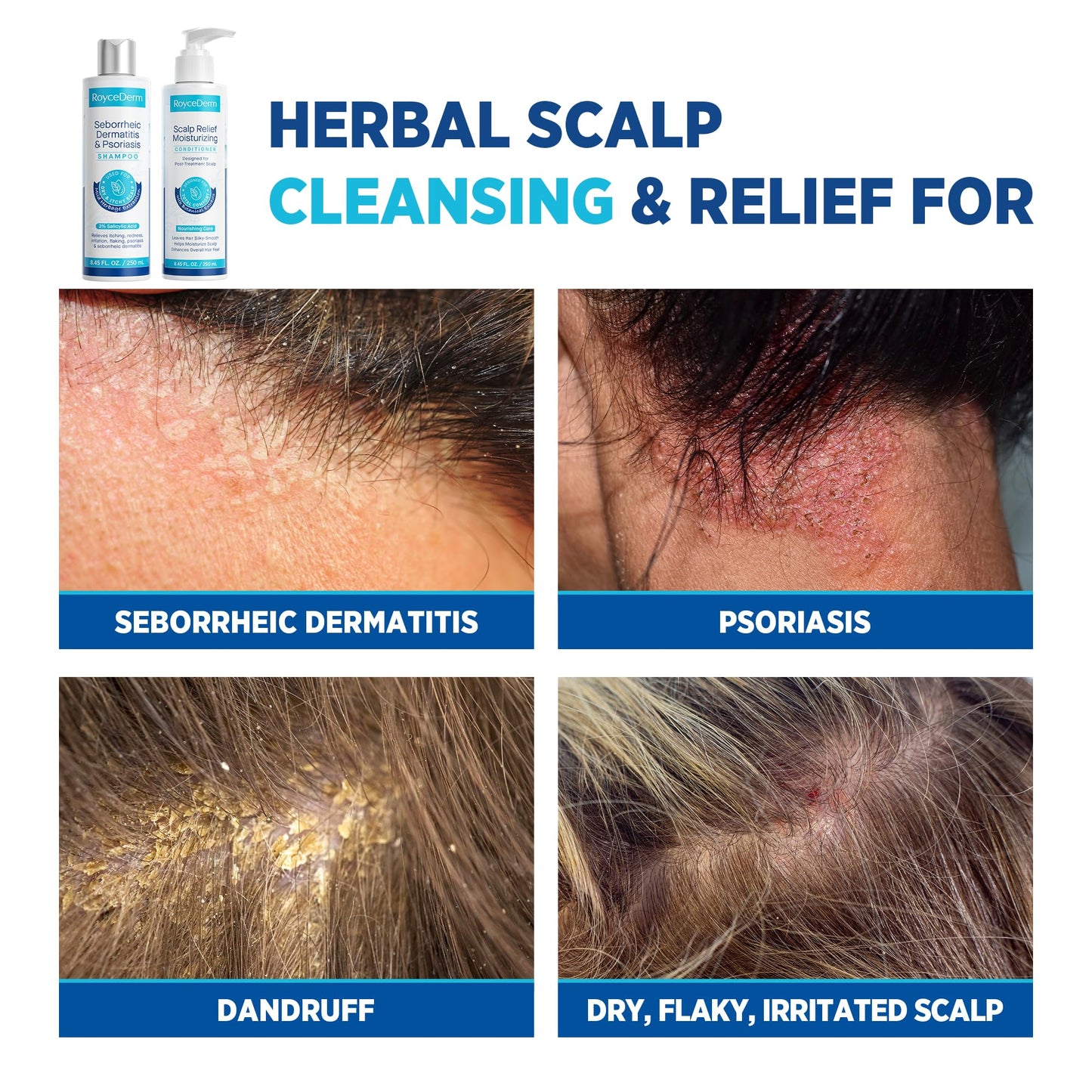 Roycederm Seborrheic Dermatitis & Psoriasis Shampoo and Conditioner Set - Effective Scalp Treatment for Folliculitis, Psoriasis, Dandruff, Dry Itchy Scalp - Soothing, Moisturizing Herbal Formula