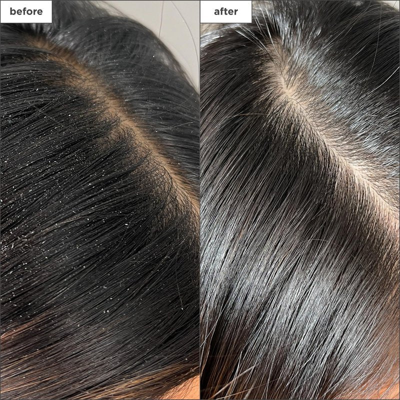 Briogeo Scalp Revival Charcoal + Tea Tree Buildup Detox Spray | Pre-Wash Scalp Exfoliating Treatment for Product Buildup, Dry Shampoo Residue & Oily Roots | Vegan & Cruelty Free | 4 oz
