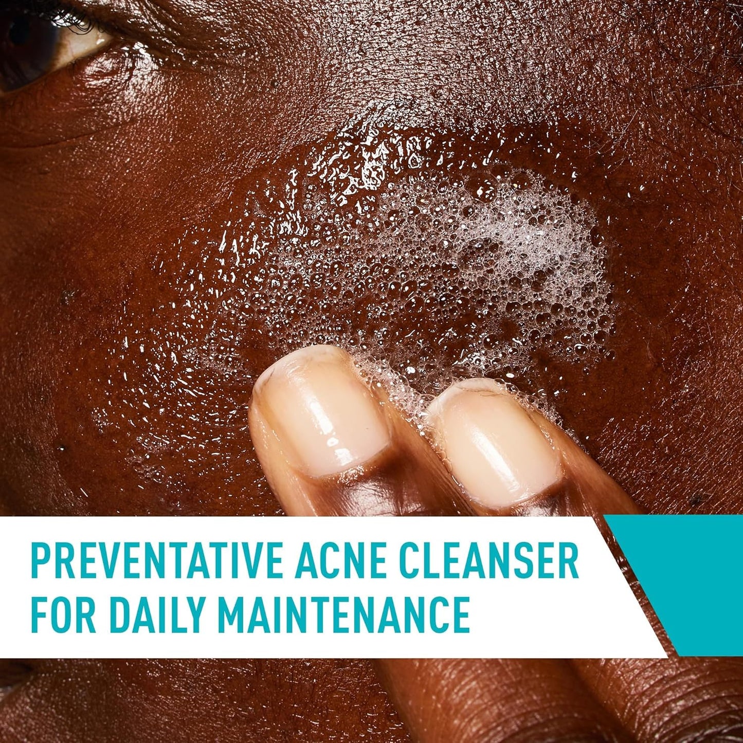 CeraVe Acne Treatment Face Wash - Salicylic Acid Cleanser with Clay & Niacinamide | 8 Ounce