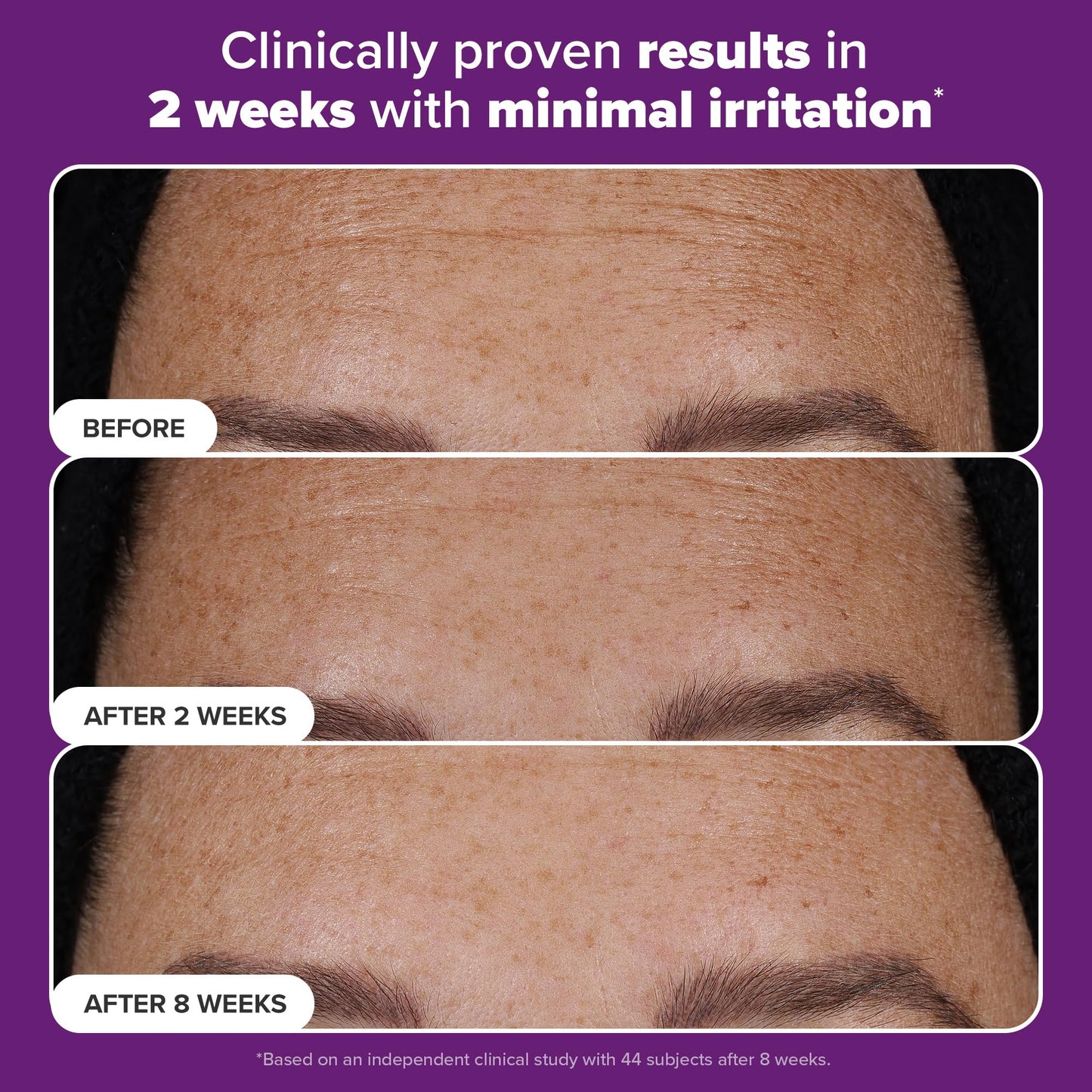 Paula’s Choice Pro Retinaldehyde Dual-Retinoid Advanced Treatment, High Potency Anti-Aging Serum for Breakout-Prone Skin, Radiance & Rough, Bumpy Texture, Fragrance-Free, 0.17 Fl. Oz.