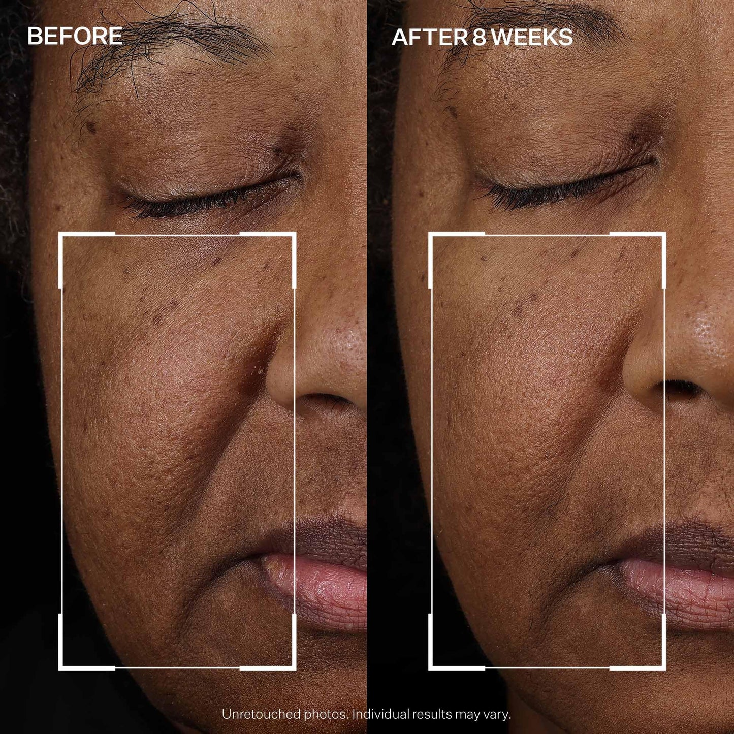 StriVectin Tighten and Lift Peptight Face Lift Serum with Tightening and Brightening Peptides for Wrinkles, Under Eye Bags and Puffiness, 30 mL
